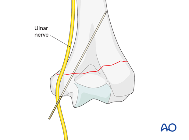Ulnar nerve is at risk and needs to be exposed, released, and protected before inserting a medial column K-wire.
