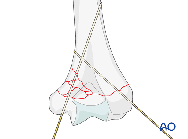 Temporary K-wire stabilization of both columns