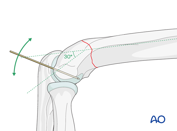 A K-wire introduced into the trochlea can be used as a joystick to rotate the distal fragment and restore the angle of anterior inclination of the lateral condylar mass in relation to the humeral shaft axis.