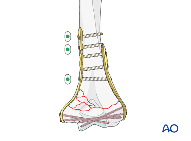 Medial plate application in neutral mode