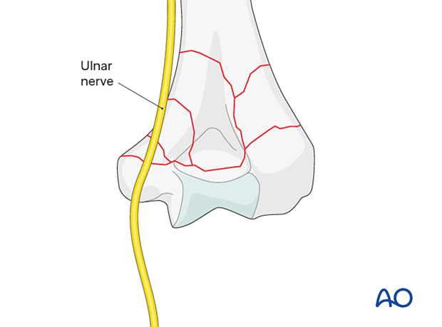 Ulnar nerve is at risk if the fracture exits just above the medial condyle.