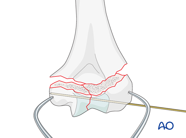 Temporary K-wire stabilization of the intraarticular fracture