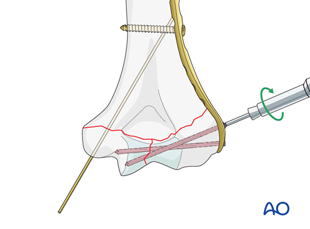 Insertion of locking screws into the articular block 