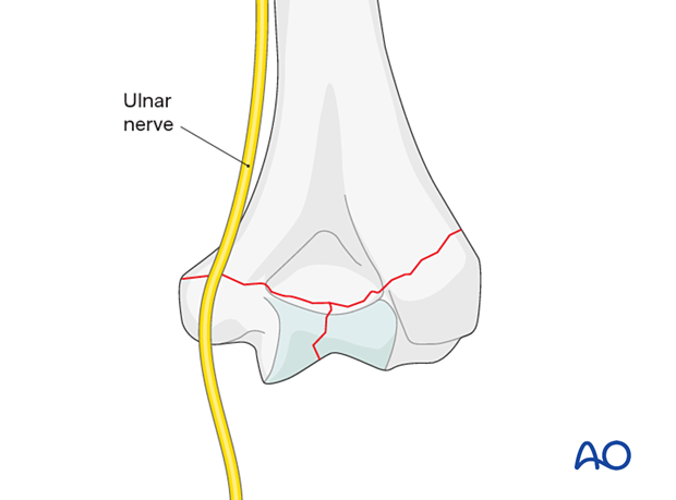 Ulnar nerve at risk if the fracture exits just above the medial condyle.
