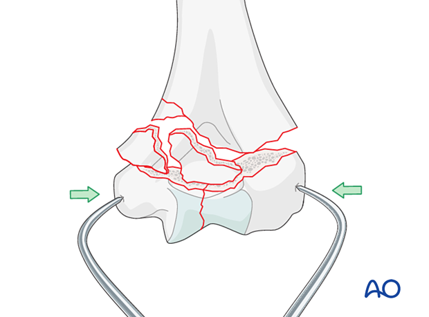 Holding the reduction of the articular block with forceps, gaining extrinsic interfragmentary compression