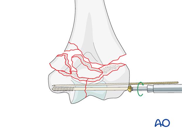 Lag screw fixation of the intraarticular fracture