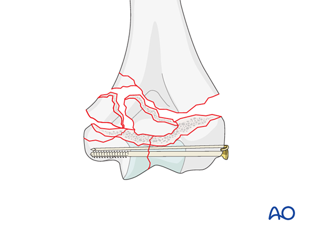 Lag screw fixation of the intraarticular fracture with additional K-wire