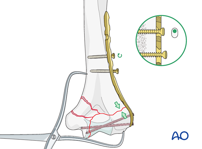 ORIF - Plate fixation for Complete articular fracture, simple articular ...