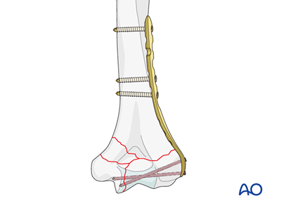 ORIF - Plate fixation for Complete articular fracture, simple articular ...