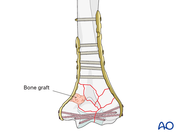 In case of great metaphyseal comminution, or missing bone, use a bone graft or the preserved fracture fragments.