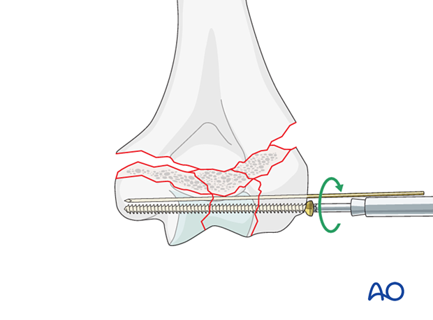 Position screw fixation of the intraarticular fracture