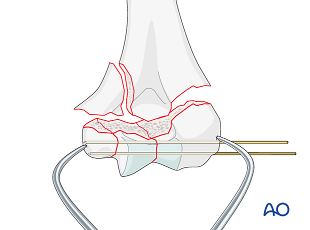 Temporary K-wire stabilization of the intraarticular fracture