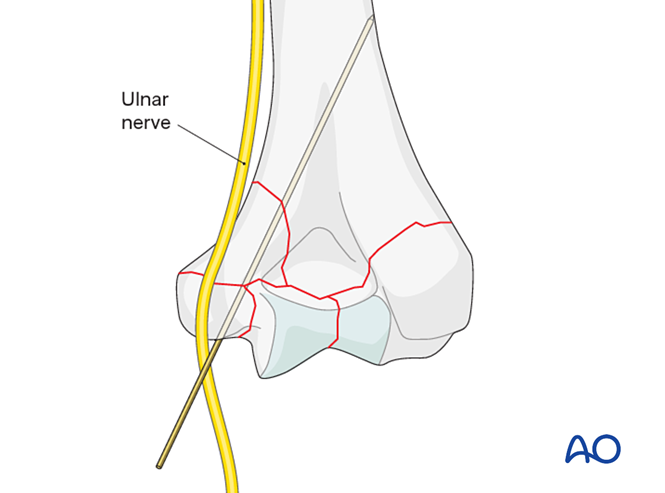 ORIF - Plate fixation for Complete and multifragmentary articular fracture