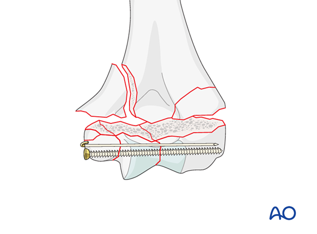 Position screw fixation of the intraarticular fracture with additional K-wire