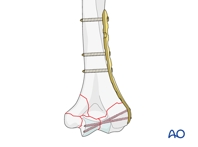 ORIF - Plate fixation for Complete and multifragmentary articular fracture