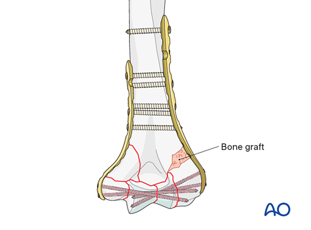 In case of great metaphyseal comminution, or missing bone, use a bone graft or the preserved fracture fragments.