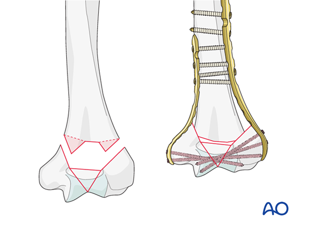 In case of significant metaphyseal comminution, the humerus can be shortened to achieve supracondylar compression