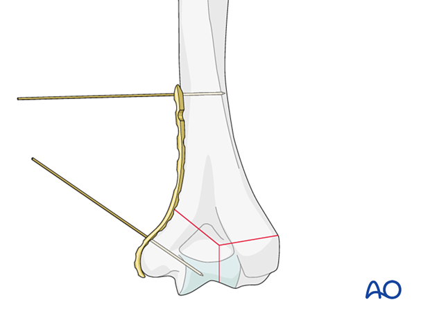 Placing the plate to the medial aspect of the distal humerus, distally on top of the soft tissues