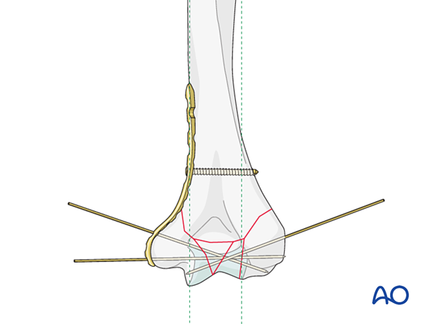 Reconstruction of the articular block with K-wires
