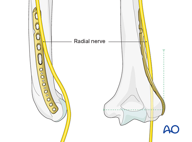 When applying a longer lateral plate, identify and protect the radial nerve to avoid injury.