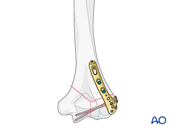 Dorsolateral plat with lateral tab