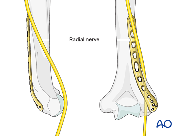When applying a longer dorsolateral plate, identify and protect the radial nerve to avoid injury.