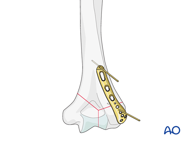 Placing the plate to the dorsolateral aspect of the distal humerus beneath the triceps