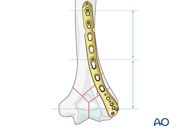 Bridge plating of complex column fracture with near-far screw insertion