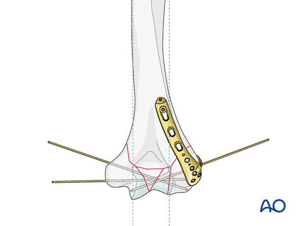 Reconstruction of the articular block with K-wires