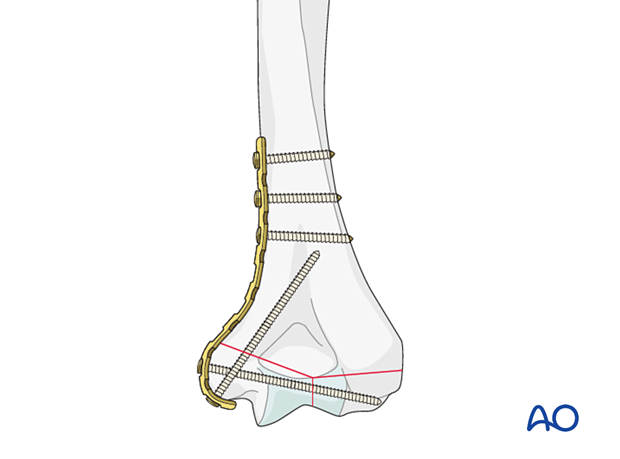 If the fracture exits low on the medial side, bend the plate around the epicondyle to allow for an ascending screw for additional stability.