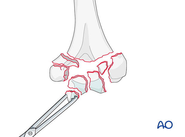 Removing fractured articular fragments