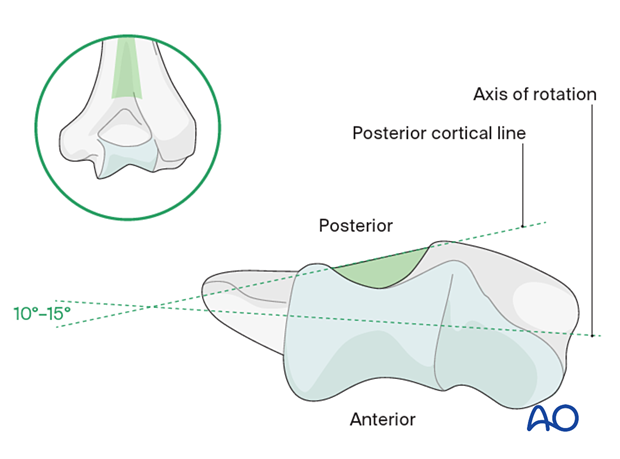 Posterior cortical line and axis of rotation
