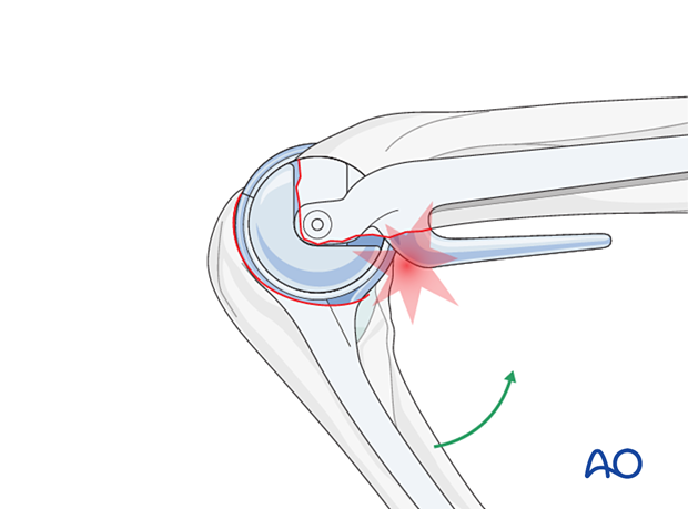 Ensure the coronoid does not impinge against the anterior flange of the humeral component as this can be a cause for loosening.