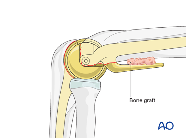 Insertion of a cancellous bone graft between the anterior humeral cortex and the anterior flange of the humeral component