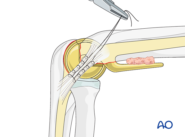 Repair of fractured condyles and collateral ligaments around the humeral component