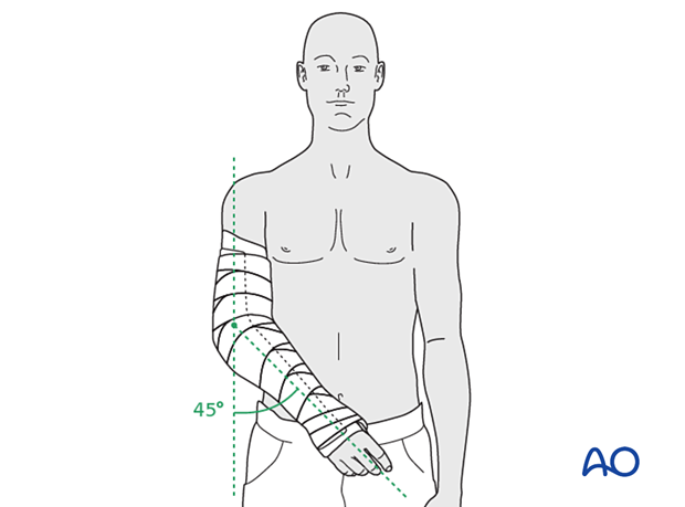 Resting the elbow in semiextension using a splint