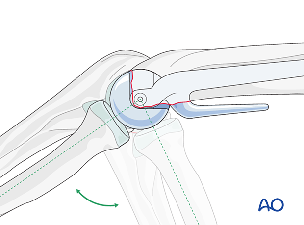 Reduce the joint and confirm that the prosthesis tracks correctly with the native ulna and radial head in all positions of flexion and extension.