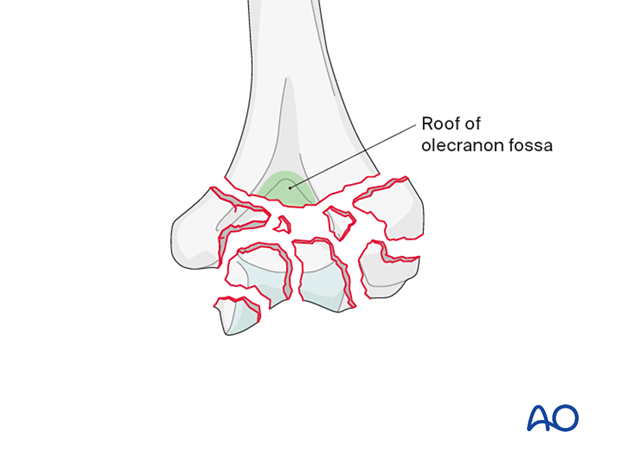 The roof of the olecranon fossa remains in continuity with the humeral shaft regardless of fracture comminution.