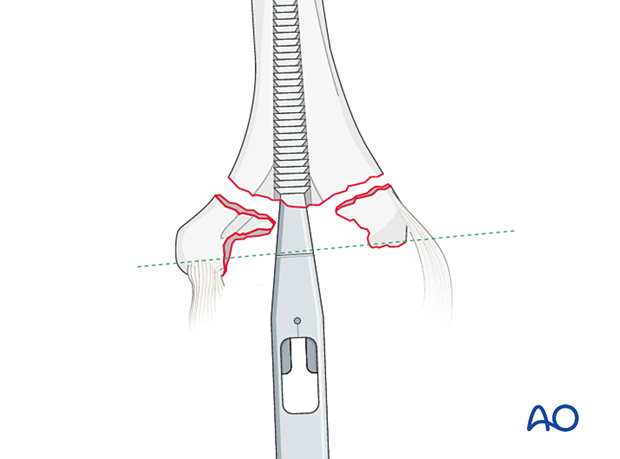 Broaching up to the depth where the laser line on the broaching instrument is parallel to the flexion/extension axis of the humerus