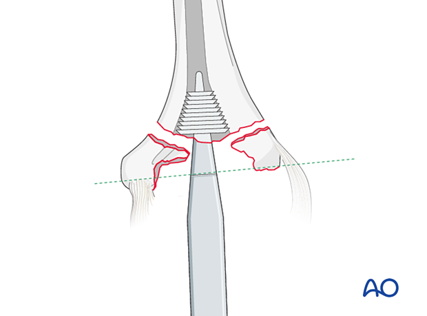To prepare for the fins of the humeral component, insert the gusset broach in correct rotation into the humerus until the laser line is level with the flexion/extension axis of the humerus.