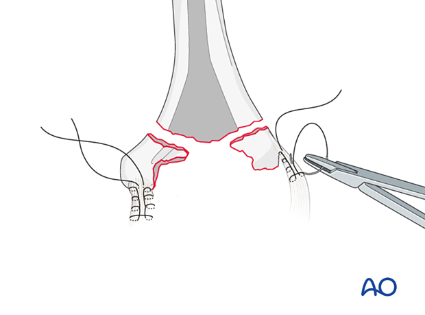 Preparation of collateral ligaments with stitches for later repair around the prosthesis