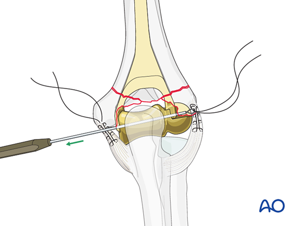 Repair of collateral ligament and condyle