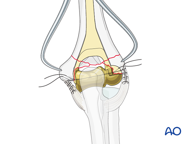 Reduce the condyles anatomically around the prosthesis using reduction forceps.