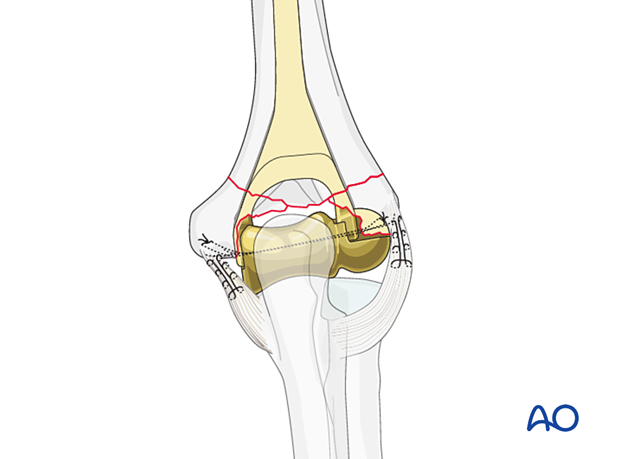 Tighten the collateral ligament sutures on either side of the implant and remove the reduction forceps.
