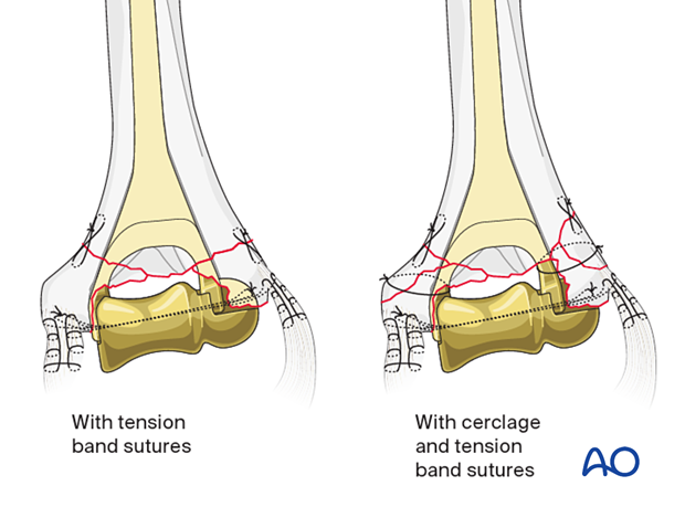 Cerclage and tension band sutures around the condyles, around the implant, and through the humerus
