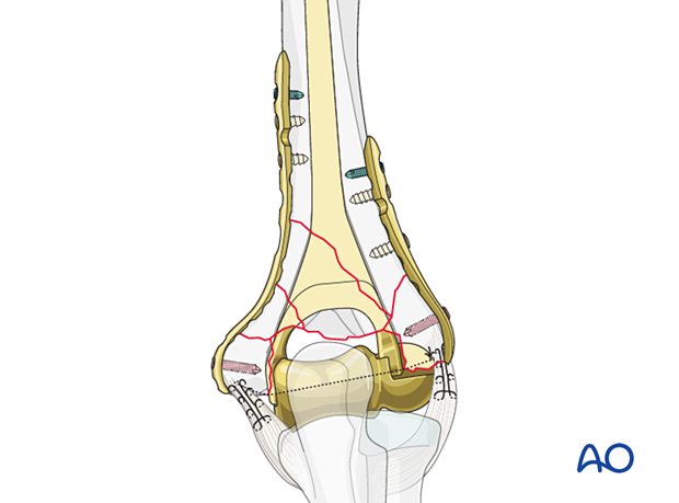 Hemiarthroplasty of the elbow with plating of epicondyles