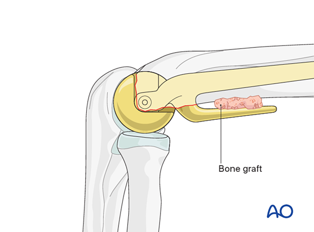 Insertion of a cancellous bone graft between the anterior humeral cortex and the anterior flange of the implant