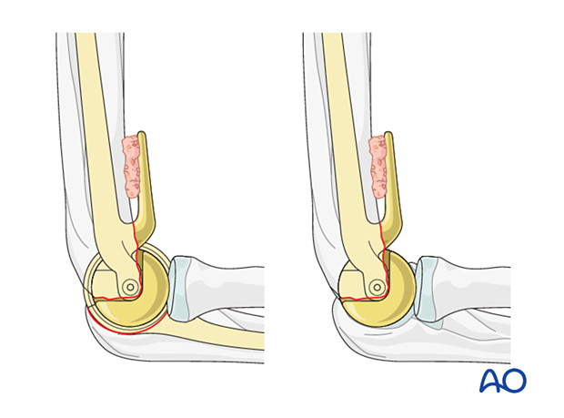 Total elbow arthroplasty and hemiarthroplasty
