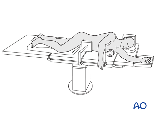 Lateral decubitus position