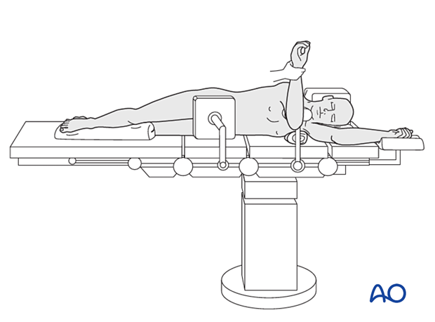 Lateral decubitus position